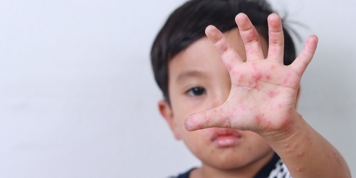 Ketahui Gejala, Penyebab, dan Pengobatan Flu Singapura Pada Anak